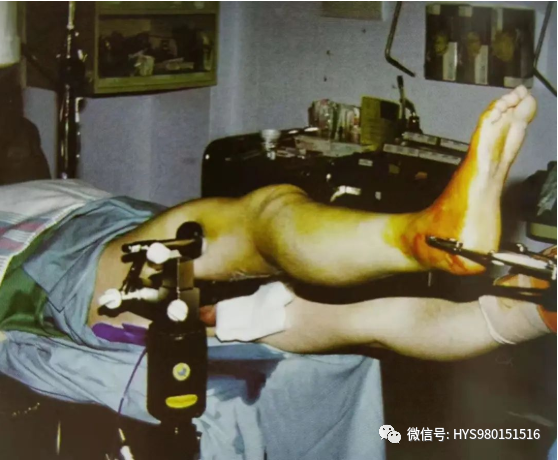 什么是外固定架胫骨近端骨折：环形外固定架_https://www.jmylbn.com_新闻资讯_第15张
