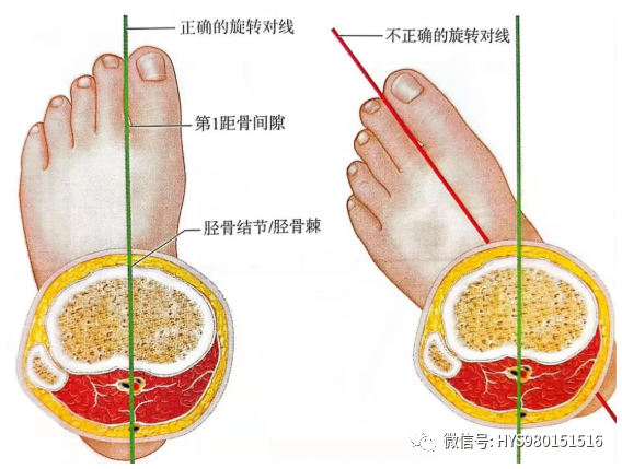 什么是外固定架胫骨近端骨折：环形外固定架_https://www.jmylbn.com_新闻资讯_第30张