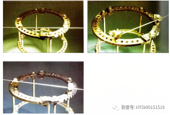 什么是外固定架胫骨近端骨折：环形外固定架_https://www.jmylbn.com_新闻资讯_第32张