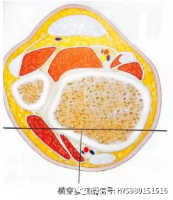 什么是外固定架胫骨近端骨折：环形外固定架_https://www.jmylbn.com_新闻资讯_第29张