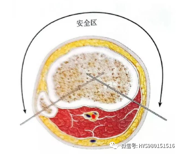 什么是外固定架胫骨近端骨折：环形外固定架_https://www.jmylbn.com_新闻资讯_第11张