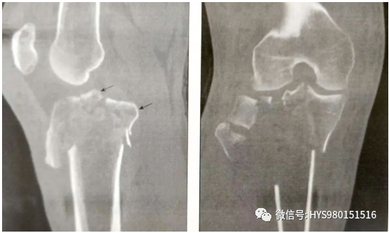 什么是外固定架胫骨近端骨折：环形外固定架_https://www.jmylbn.com_新闻资讯_第8张