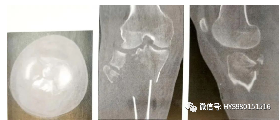 什么是外固定架胫骨近端骨折：环形外固定架_https://www.jmylbn.com_新闻资讯_第7张