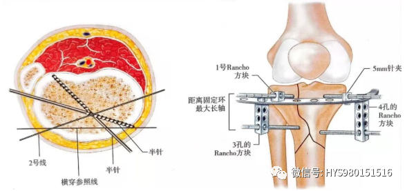 什么是外固定架胫骨近端骨折：环形外固定架_https://www.jmylbn.com_新闻资讯_第35张