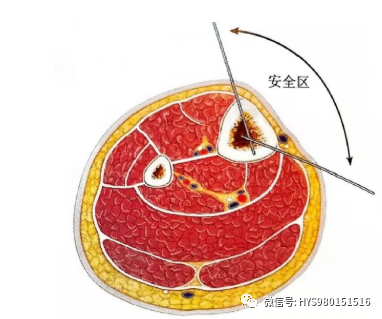 什么是外固定架胫骨近端骨折：环形外固定架_https://www.jmylbn.com_新闻资讯_第12张