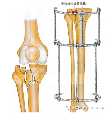 什么是外固定架胫骨近端骨折：环形外固定架_https://www.jmylbn.com_新闻资讯_第17张