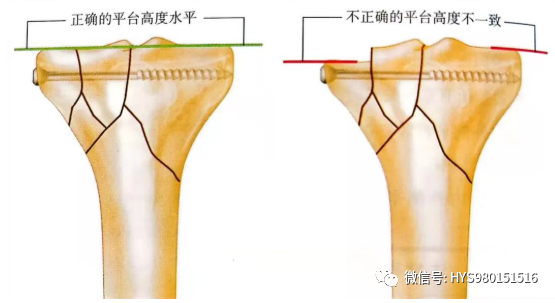 什么是外固定架胫骨近端骨折：环形外固定架_https://www.jmylbn.com_新闻资讯_第23张