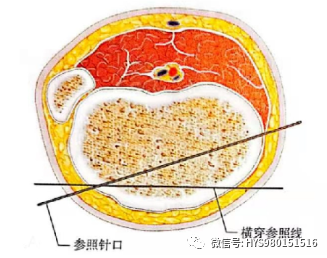 什么是外固定架胫骨近端骨折：环形外固定架_https://www.jmylbn.com_新闻资讯_第26张