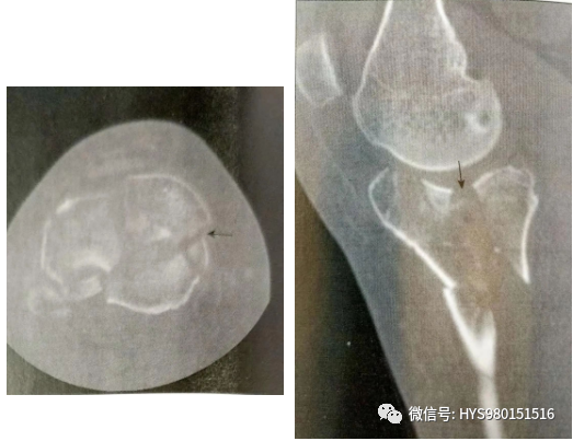 什么是外固定架胫骨近端骨折：环形外固定架_https://www.jmylbn.com_新闻资讯_第6张