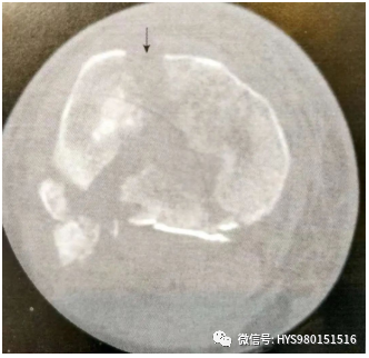 什么是外固定架胫骨近端骨折：环形外固定架_https://www.jmylbn.com_新闻资讯_第9张