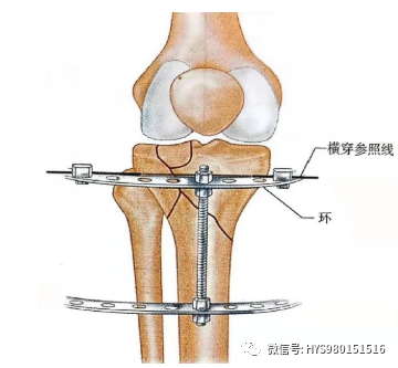 什么是外固定架胫骨近端骨折：环形外固定架_https://www.jmylbn.com_新闻资讯_第25张