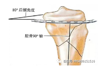 什么是外固定架胫骨近端骨折：环形外固定架_https://www.jmylbn.com_新闻资讯_第28张