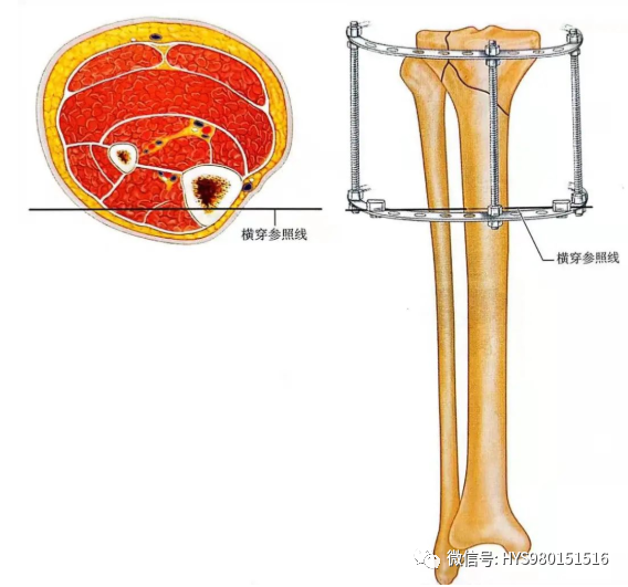 什么是外固定架胫骨近端骨折：环形外固定架_https://www.jmylbn.com_新闻资讯_第31张