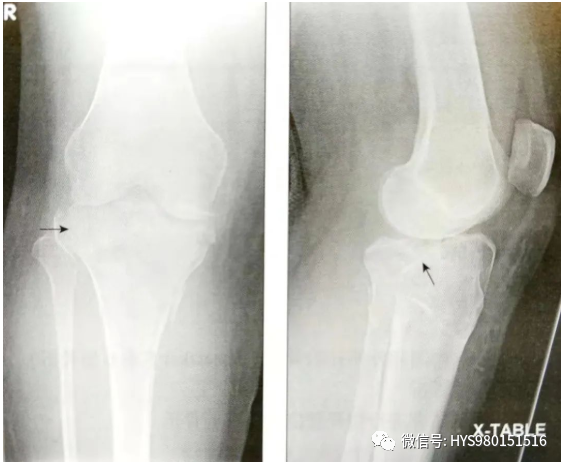 什么是外固定架胫骨近端骨折：环形外固定架_https://www.jmylbn.com_新闻资讯_第5张