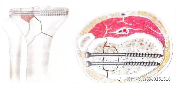 什么是外固定架胫骨近端骨折：环形外固定架_https://www.jmylbn.com_新闻资讯_第21张