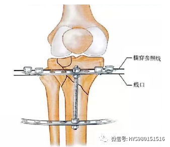 什么是外固定架胫骨近端骨折：环形外固定架_https://www.jmylbn.com_新闻资讯_第27张