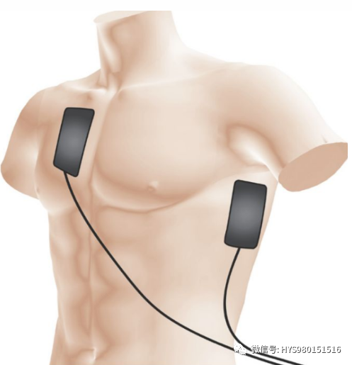 aed电极贴怎么贴2分钟学会AED使用方法！关键时刻能救命！_https://www.jmylbn.com_新闻资讯_第21张