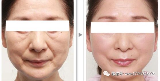 pga和pgla有什么区别早读 ｜ 线雕干货！5大角度深度讲解_https://www.jmylbn.com_新闻资讯_第15张