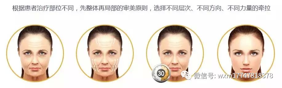 pga和pgla有什么区别早读 ｜ 线雕干货！5大角度深度讲解_https://www.jmylbn.com_新闻资讯_第14张