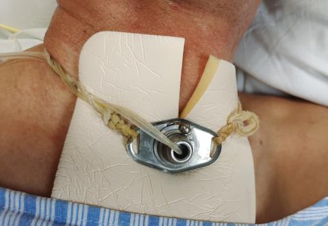 纱布敷料怎么用气管切开如何使用泡沫敷料_https://www.jmylbn.com_新闻资讯_第6张