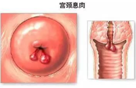 射频妇科是什么RF4®•锐扶刀妇科射频治疗仪‖治疗宫颈息肉安全快捷_https://www.jmylbn.com_新闻资讯_第1张