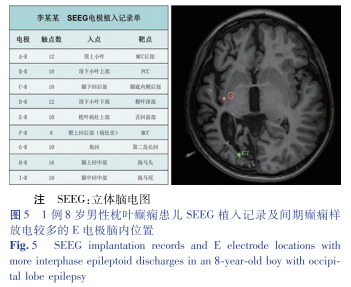 16导脑电图怎么放置病例报告／兰正波 立体脑电图引导下射频热凝治疗儿童继发性枕叶癫痫1例并文献复习_https://www.jmylbn.com_新闻资讯_第7张