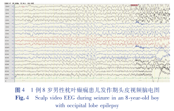 16导脑电图怎么放置病例报告／兰正波 立体脑电图引导下射频热凝治疗儿童继发性枕叶癫痫1例并文献复习_https://www.jmylbn.com_新闻资讯_第6张