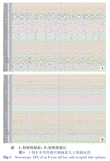 16导脑电图怎么放置病例报告／兰正波 立体脑电图引导下射频热凝治疗儿童继发性枕叶癫痫1例并文献复习_https://www.jmylbn.com_新闻资讯_第8张