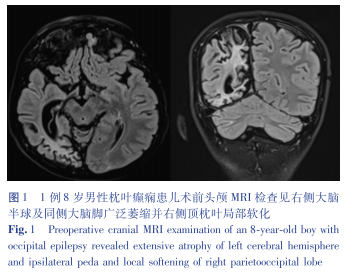 16导脑电图怎么放置病例报告／兰正波 立体脑电图引导下射频热凝治疗儿童继发性枕叶癫痫1例并文献复习_https://www.jmylbn.com_新闻资讯_第4张