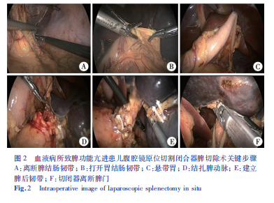 切割闭合器怎么用小儿微创外科技术专题／王建尧 应用直线切割闭合器行腹腔镜原位脾切除术治疗儿童血液病所致脾功能亢进的临床研究_https://www.jmylbn.com_新闻资讯_第5张