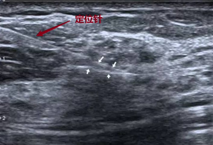为什么要定位针 乳腺“金”针定位——让乳腺小结节无处遁形！_https://www.jmylbn.com_新闻资讯_第5张