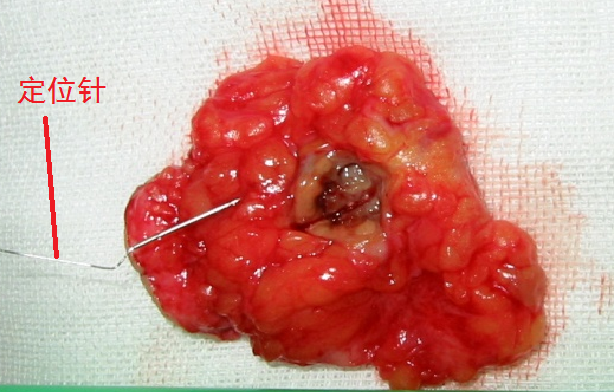 为什么要定位针 乳腺“金”针定位——让乳腺小结节无处遁形！_https://www.jmylbn.com_新闻资讯_第7张
