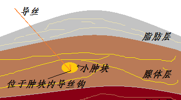 为什么要定位针 乳腺“金”针定位——让乳腺小结节无处遁形！_https://www.jmylbn.com_新闻资讯_第3张