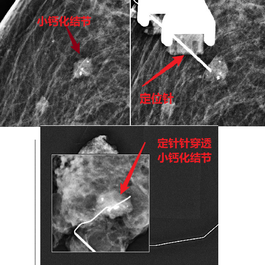 为什么要定位针 乳腺“金”针定位——让乳腺小结节无处遁形！_https://www.jmylbn.com_新闻资讯_第6张