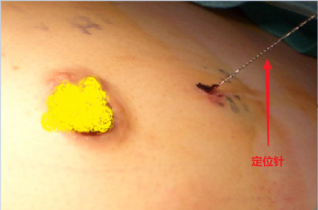 为什么要定位针 乳腺“金”针定位——让乳腺小结节无处遁形！_https://www.jmylbn.com_新闻资讯_第1张