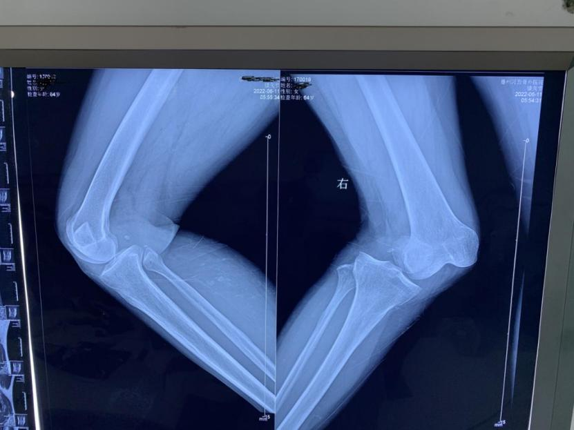 山东大学齐鲁医院德州医院开展首例关节镜下lars人工韧带重建膝关节