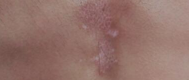 用手挤完的痘痘，竟变成了白癜风！？