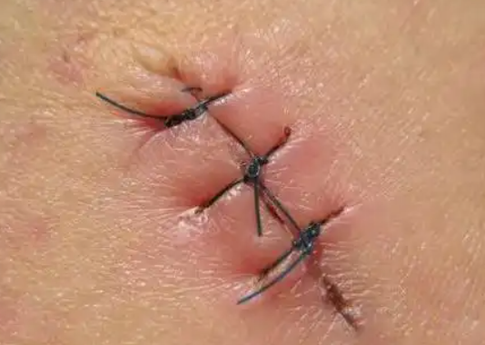 缝合皮肤用什么针【你知道吗】小来兼可隐针锋，一寸拈来一寸情——三种缝合技术让您的伤口“美”得无痕_https://www.jmylbn.com_新闻资讯_第4张