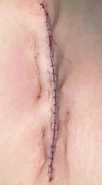 缝合皮肤用什么针【你知道吗】小来兼可隐针锋，一寸拈来一寸情——三种缝合技术让您的伤口“美”得无痕_https://www.jmylbn.com_新闻资讯_第6张