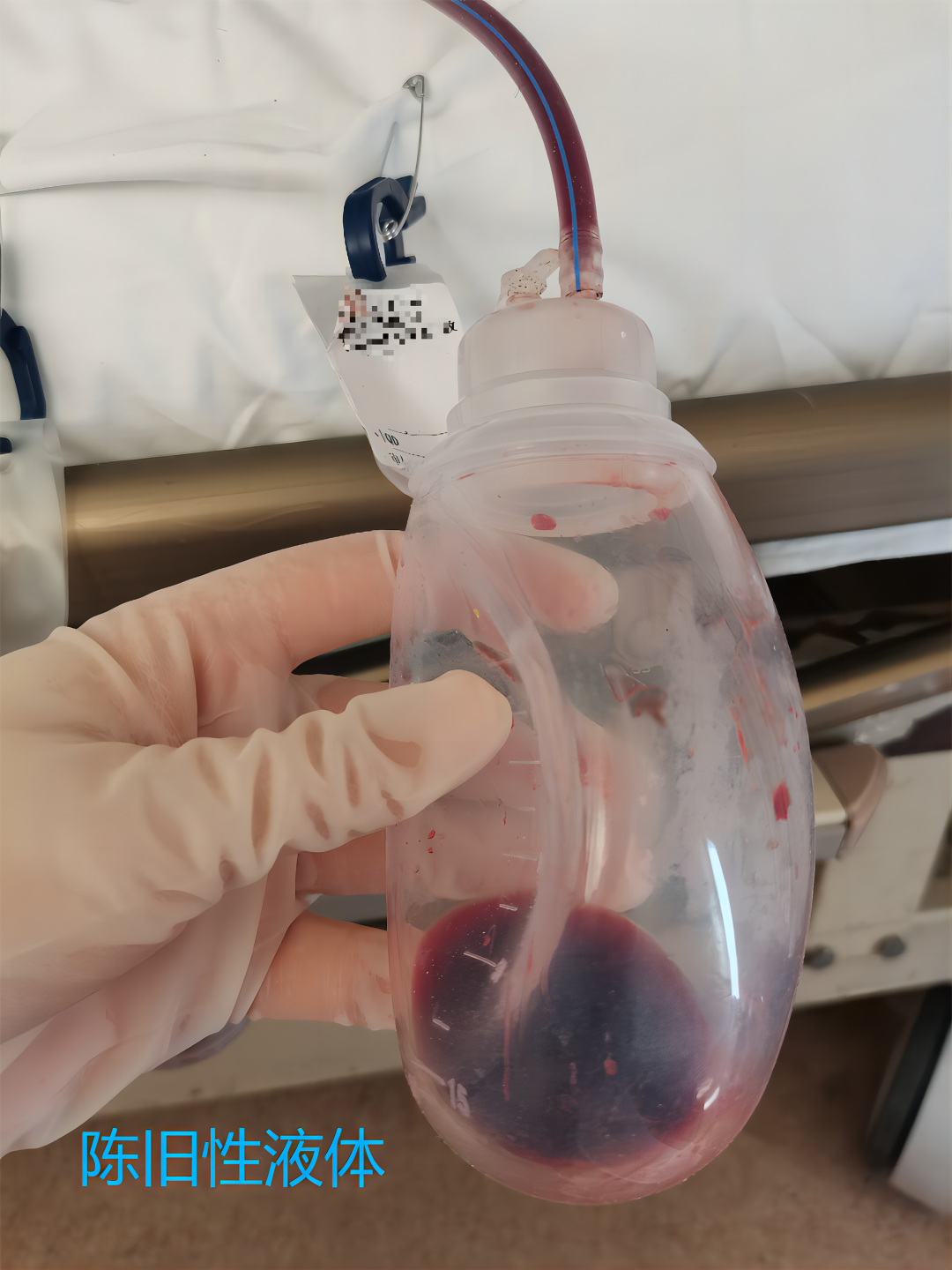 为什么负压引流【科普天地】第一期：术后为什么要放置引流管，你知道吗？_https://www.jmylbn.com_新闻资讯_第26张