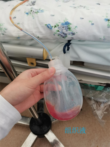 为什么负压引流【科普天地】：术后为什么要放置引流管，你知道吗？_https://www.jmylbn.com_新闻资讯_第22张