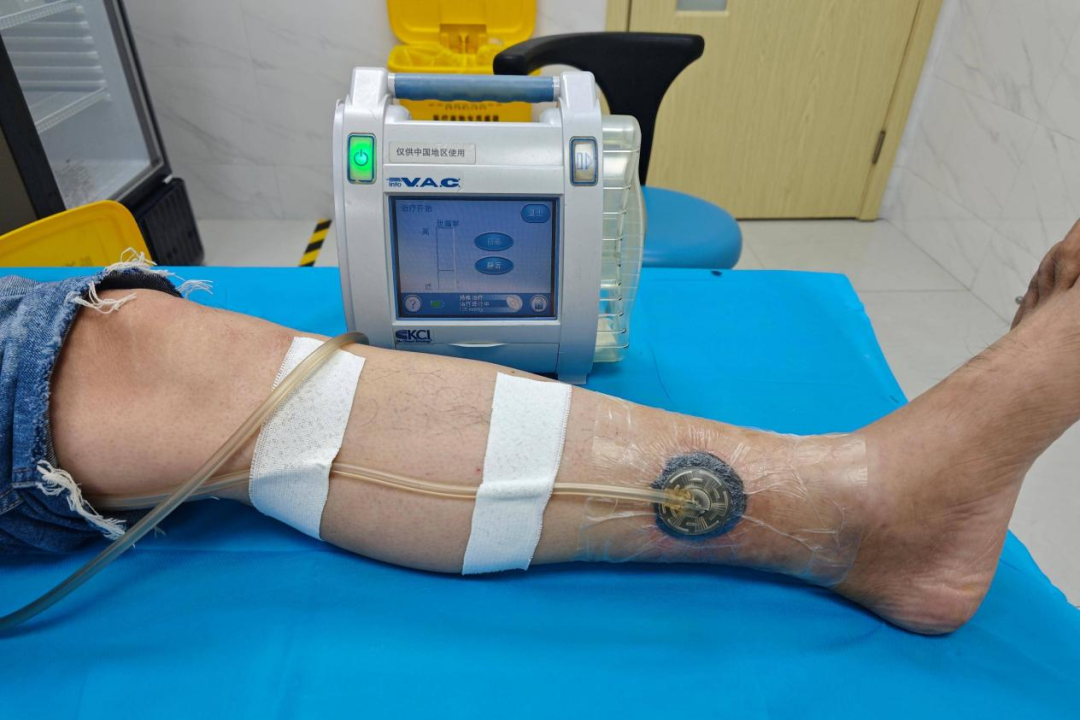 vsd引流器怎么连接田医生的外科笔记 ｜ 伤口愈合的“黑科技”：一文读懂负压封闭引流（VSD）_https://www.jmylbn.com_新闻资讯_第8张