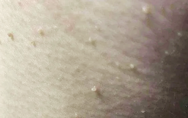 高艳青治疗hpv长在脖子上的小肉揪与尖锐湿疣有关系吗