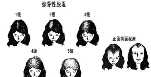 【肤康百科】换季脱发严重？别怕！是休止期脱发~