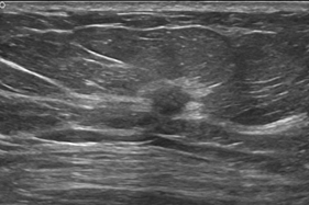 什么叫超声容积探头它是女性健康第一杀手，但早期治愈率达90%以上！最先进的自动乳腺超声成像系统来啦！_https://www.jmylbn.com_新闻资讯_第7张