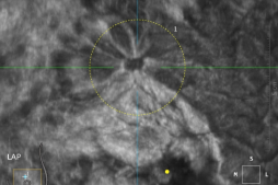 什么叫超声容积探头它是女性健康第一杀手，但早期治愈率达90%以上！最先进的自动乳腺超声成像系统来啦！_https://www.jmylbn.com_新闻资讯_第6张