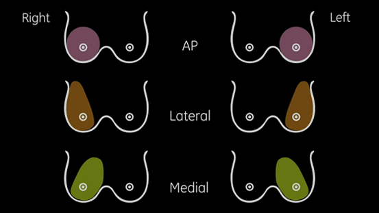 什么叫超声容积探头它是女性健康第一杀手，但早期治愈率达90%以上！最先进的自动乳腺超声成像系统来啦！_https://www.jmylbn.com_新闻资讯_第5张