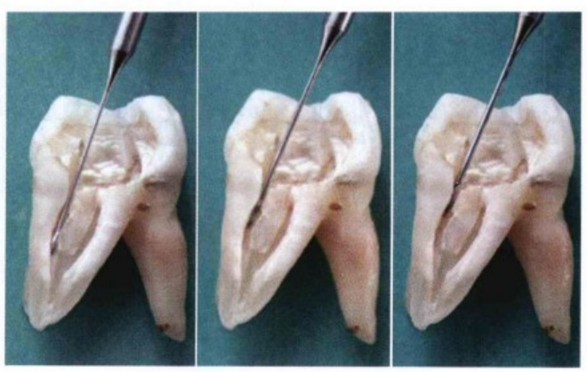 逐步后退法、冠向下法、步进法的一些常见操作解析
