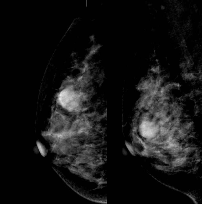 数字化摄影是什么检查好消息！助力乳腺癌早期诊断 青田人民医院数字化乳腺X线机正式投入使用_https://www.jmylbn.com_新闻资讯_第15张