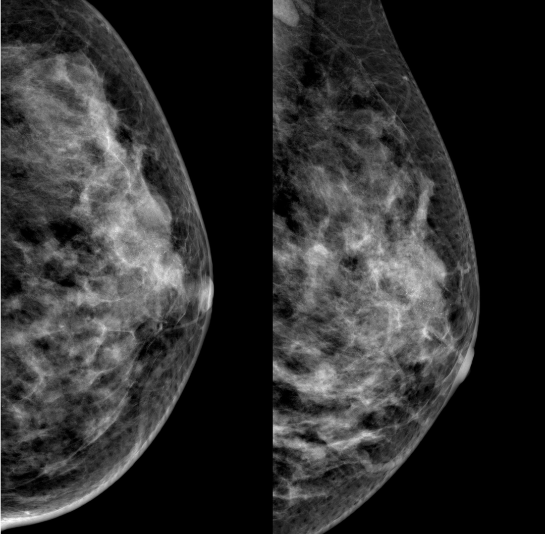 数字化摄影是什么检查好消息！助力乳腺癌早期诊断 青田人民医院数字化乳腺X线机正式投入使用_https://www.jmylbn.com_新闻资讯_第13张